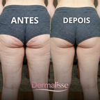 MASSAJADOR ANTICELULITE 2.0